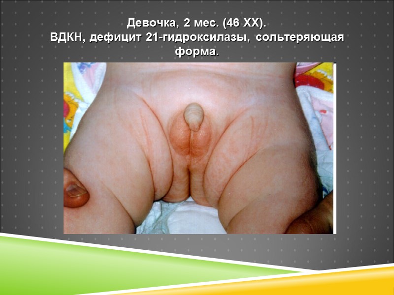 Девочка, 2 мес. (46 ХХ).  ВДКН, дефицит 21-гидроксилазы, сольтеряющая форма.